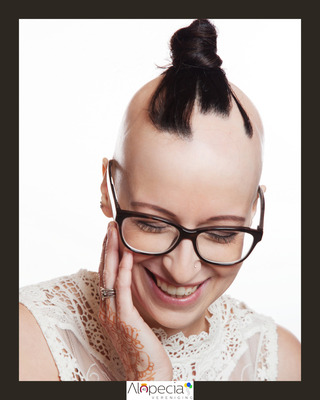 alopecia-bold-sarah-visual