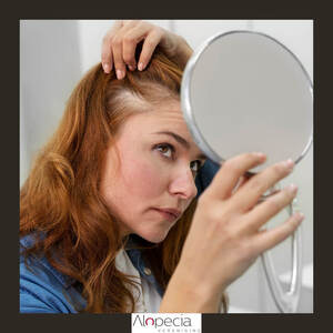 alopecia-nieuws-hairloss-visual