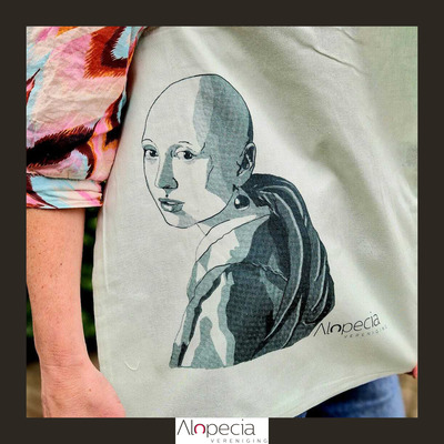 alopecia-tas-2