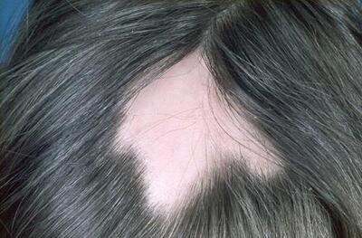 foto-1-alopecia-areata